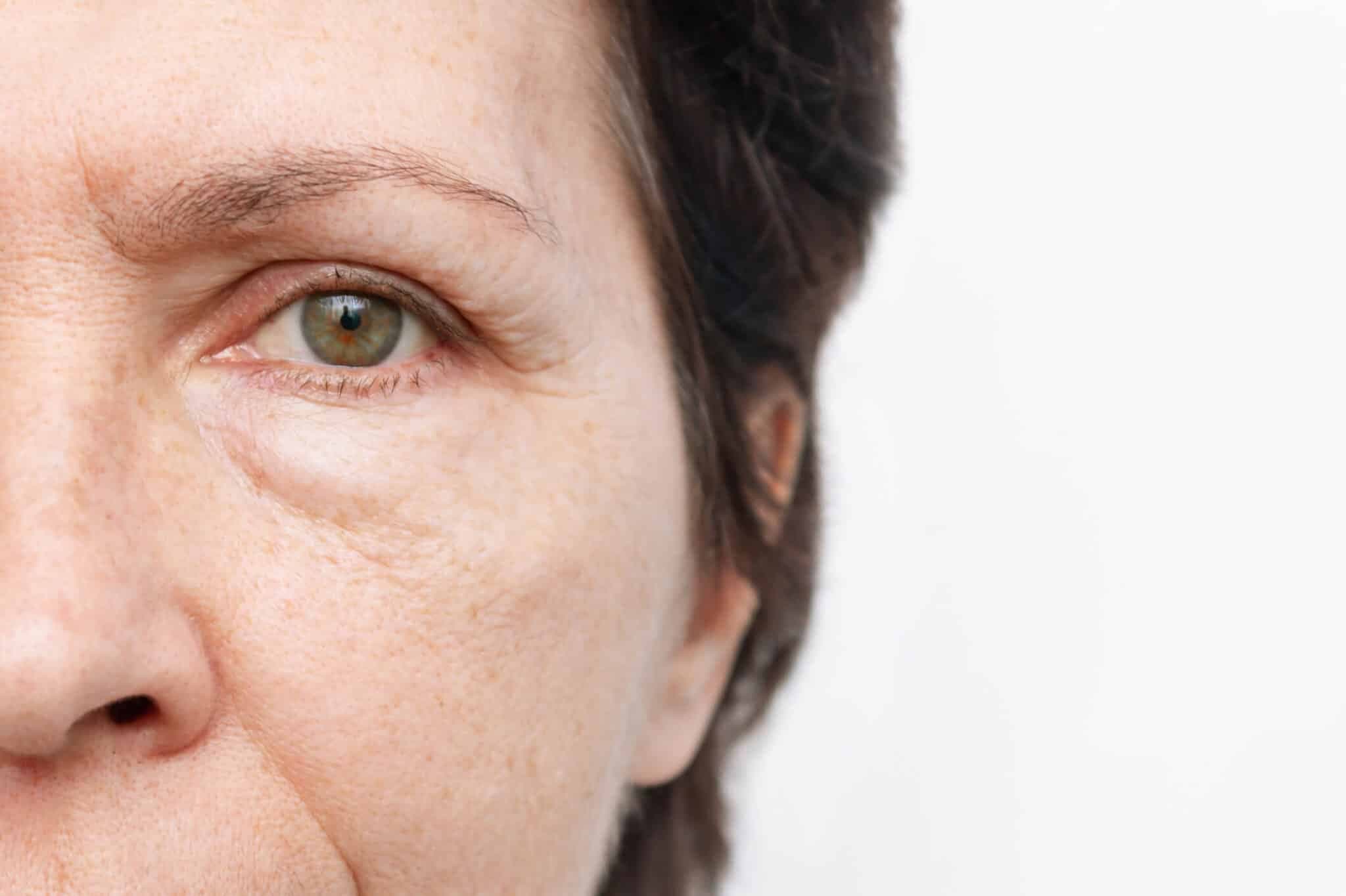 Olheira e sinais de cansaço ao redor dos olhos